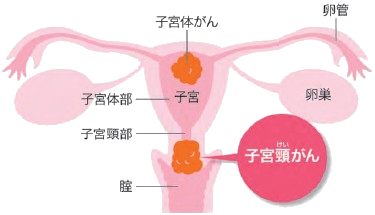 イメージ図　子宮頸がん
