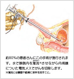 イメージ図　経尿道的膀胱腫瘍切除術