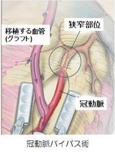イメージ図　冠動脈バイパス術