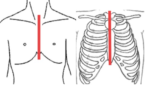 イメージ図　小切開右側方開胸開心術　従来の胸骨正中切開(約20cm)