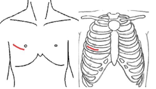 イメージ図　小切開右側方開胸開心術　右側方開胸(約8cm)