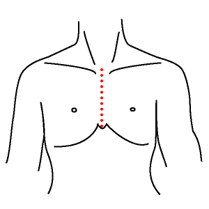 イメージ図　従来の胸骨正中切開(約20cm)