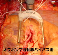 写真　オフポンプ冠動脈バイパス手術