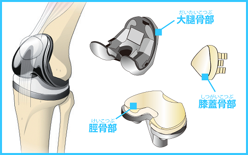 置換術イメージ