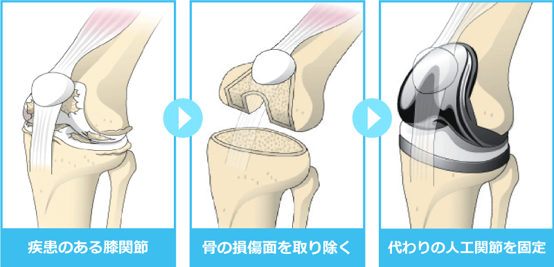 置換術イメージ