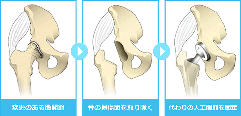 置換術イメージ