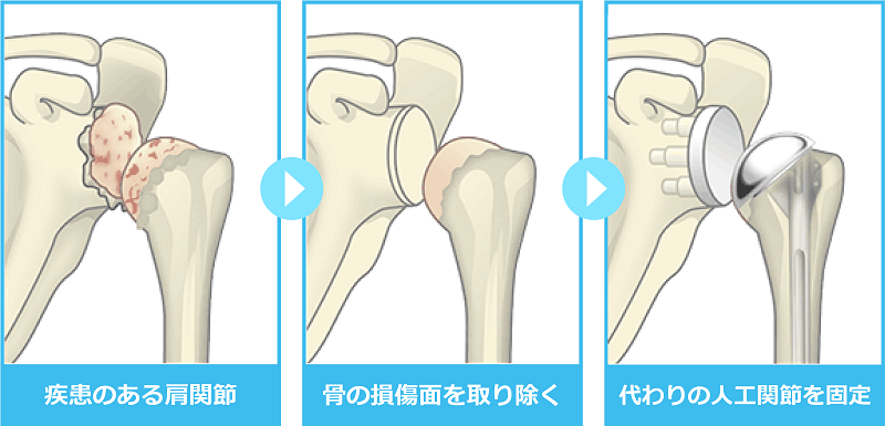 置換術イメージ