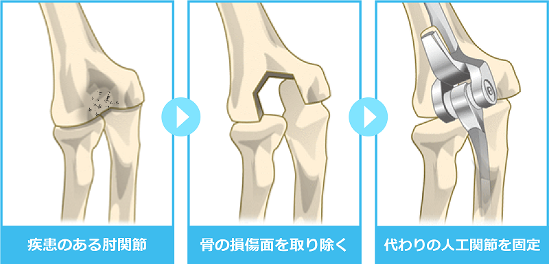 置換術イメージ