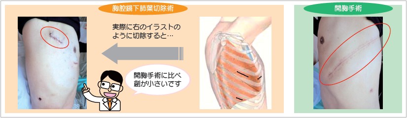 イメージ図 開胸手術と胸腔鏡下肺葉切除術の創