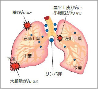 イメージ図 肺がんのできる位置