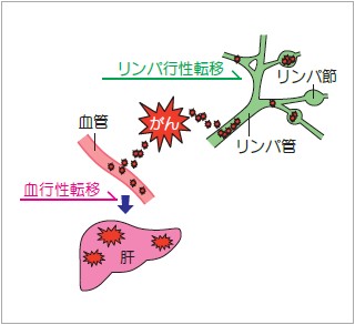 イメージ図 がんが転移するルート