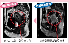 イメージ図　放射線治療の前後