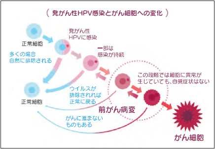 イメージ図　子宮頸がんになるまで