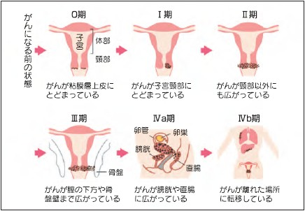 イメージ図　子宮頸がんの進行と病期