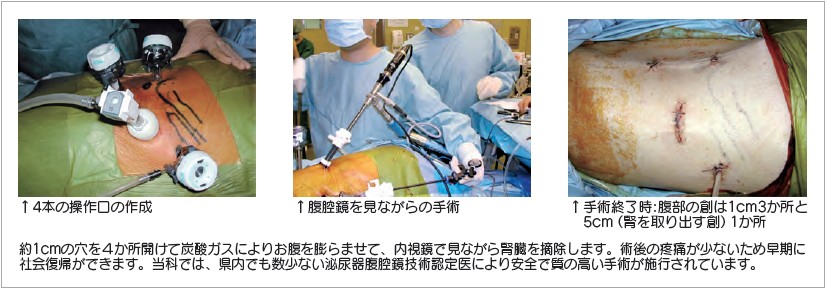 イメージ図　腹腔鏡下腎摘除術