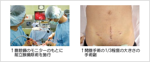 イメージ図　腹腔鏡小切開手術