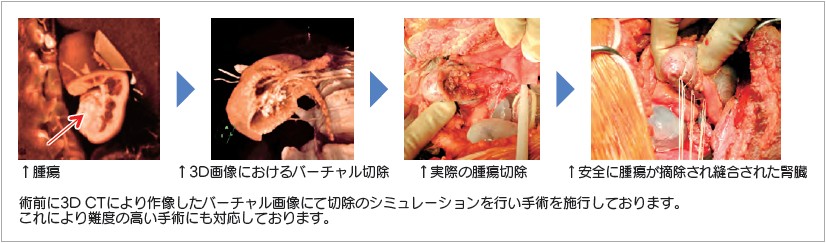 イメージ図　腎部分切除術