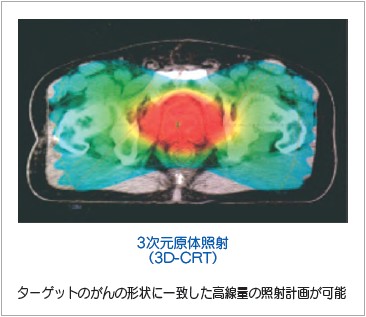 イメージ図　放射線療法