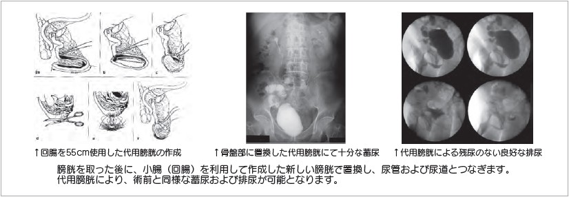 イメージ図　Studer式回腸代用膀胱造設術