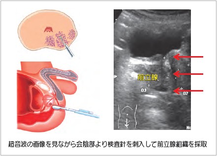 イメージ図　超音波ガイド下前立腺生検(経会陰法)
