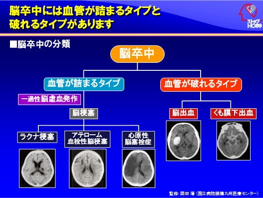 イメージ図　脳卒中の分類