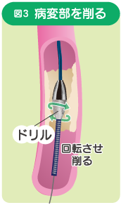 イメージ図　病変部を削る