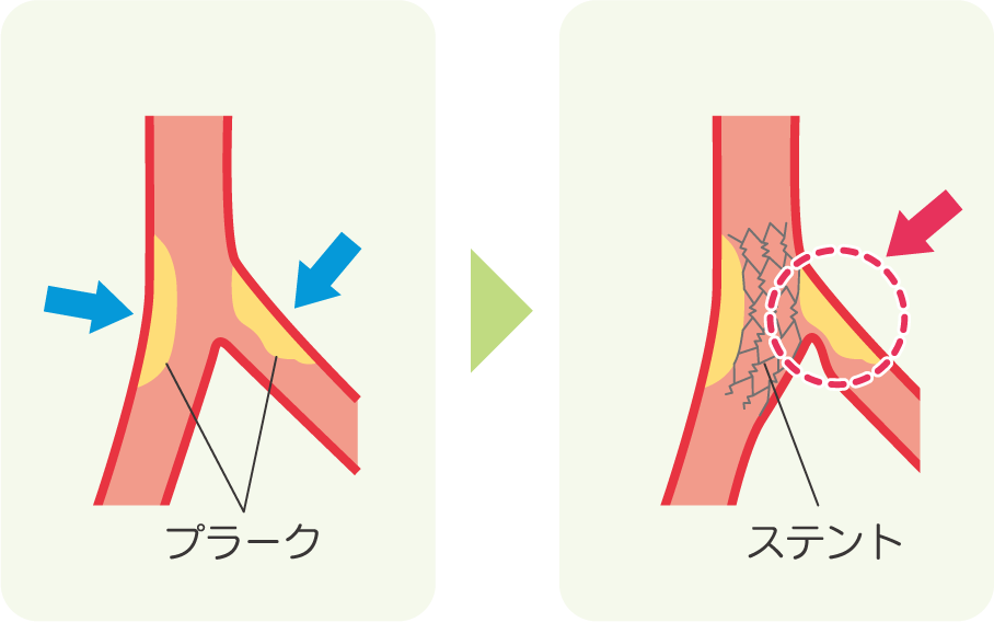 イメージ図　病変部を削る