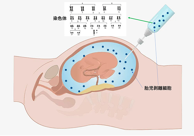 イメージ図　羊水染色体検査