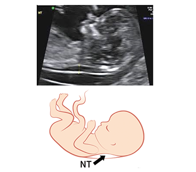 イメージ図　NT(Nuchal Translucency)