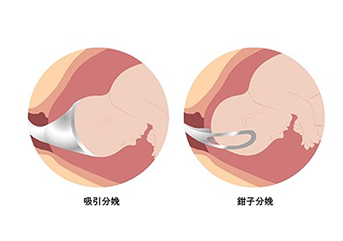 イメージ図　吸引分娩　鉗子分娩