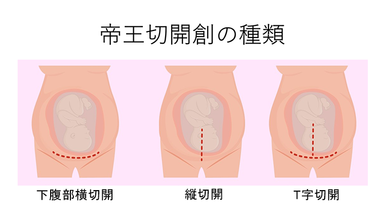 イメージ図　帝王切開創の種類