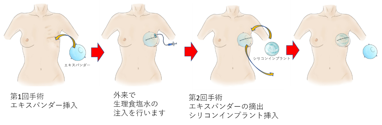 イメージ図　乳房再建