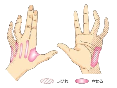 イメージ図 肘部管症候群