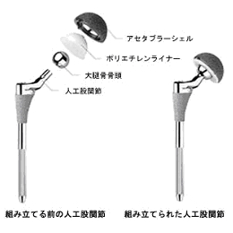 イメージ図 人工股関節置換術1