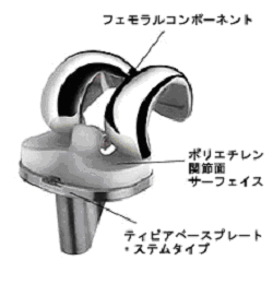 イメージ図 人工膝関節