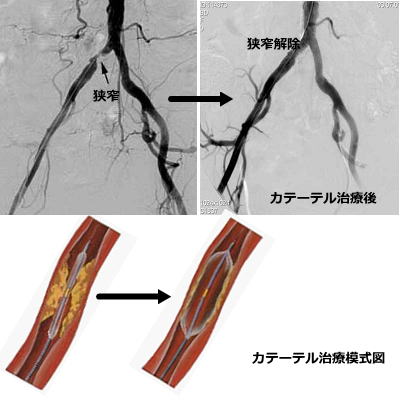 イメージ図　カテーテル治療