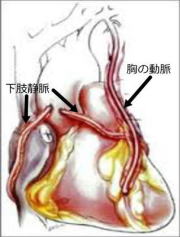 イメージ図　冠動脈