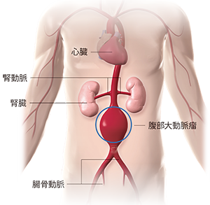 イメージ図　ステントグラフト内挿術　血管内治療