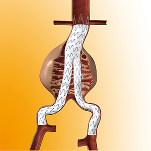 イメージ図　ステントグラフト内挿術　血管内治療
