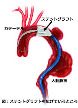 イメージ図　ステントグラフトを広げているところ