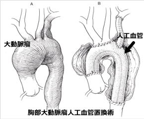 イメージ図　胸部大動脈瘤人工血管置換術