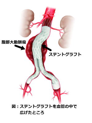 イメージ図　ステントグラフトを血管の中で広げたところ