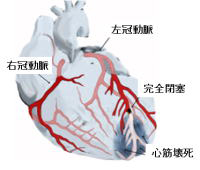 イメージ図　心筋梗塞