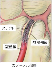 イメージ図　カテーテル治療