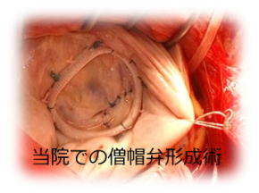 写真　当院での僧房弁形成術