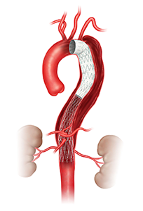 イメージ図　ステントグラフト治療（B型解離）