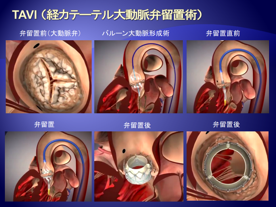 TAVI（カテーテル大動脈弁留置術）