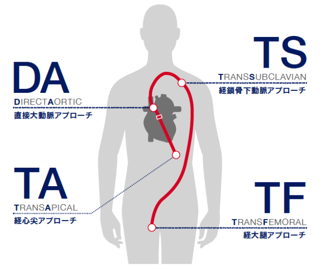 TAVI（カテーテル大動脈弁留置術）