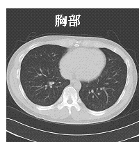 写真 胸部CT画像